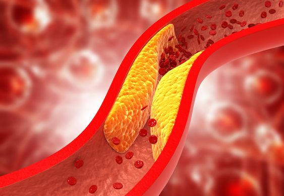 How to Manage High Cholesterol